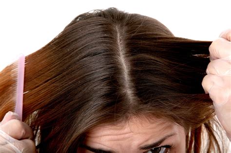 What is Scalp Psoriasis? - Revere Health