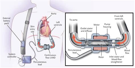 Current Status of Left Ventricular Assist Device Technology - Seminars in Thoracic and ...