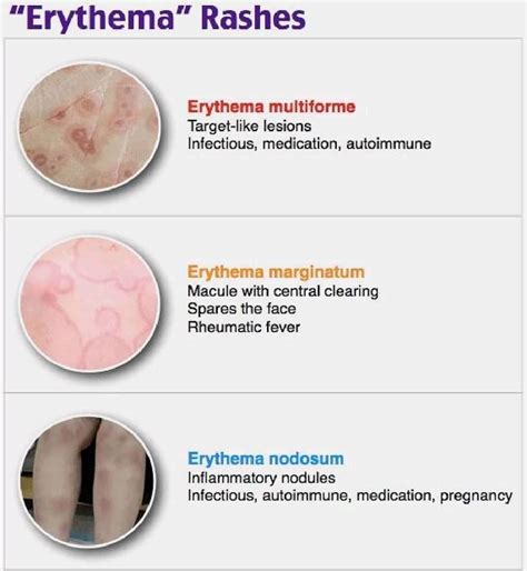 Erythema Marginatum Vs Erythema Multiforme