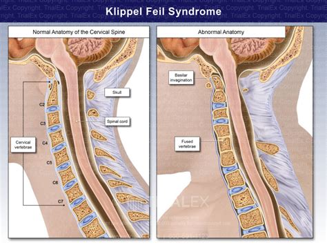 Klippel Feil Syndrome - TrialQuest Inc.