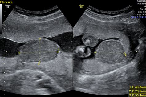 Successful expectant management of a giant chorioangioma | BMJ Case Reports