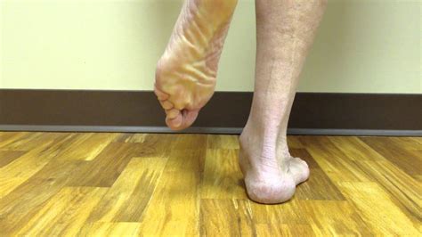 Posterior Tibial Tendon Dysfunction, Post-Treatment - YouTube