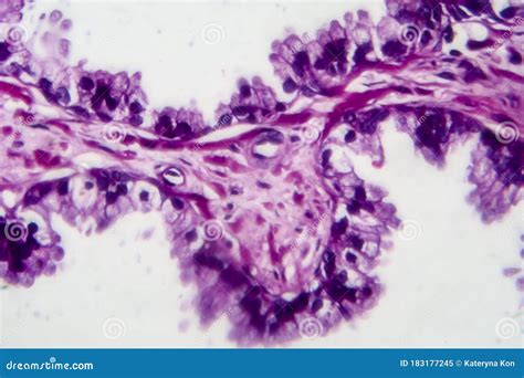 Prostate Cancer, Light Micrograph Stock Image - Image of magnification, carcinoma: 183177245