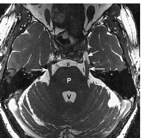 Trigeminal Nerve Mri Sagittal