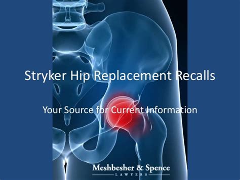 Stryker Hip Replacement Recall - Your Source for Information