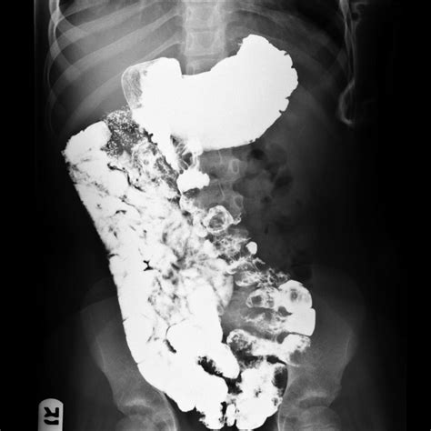 Intestinal malrotation - abnormal distribution of the small bowel. The ...