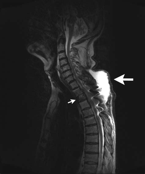 MRI of the thoracic spine (T2-weighted, sagittal reconstruction). The... | Download Scientific ...