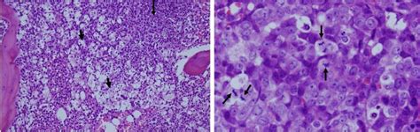 Tumor Lysis Syndrome | Concise Medical Knowledge