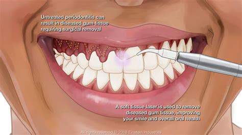 Is Gum Contouring Safe? - Best Dental | Dr. Jasmine Naderi