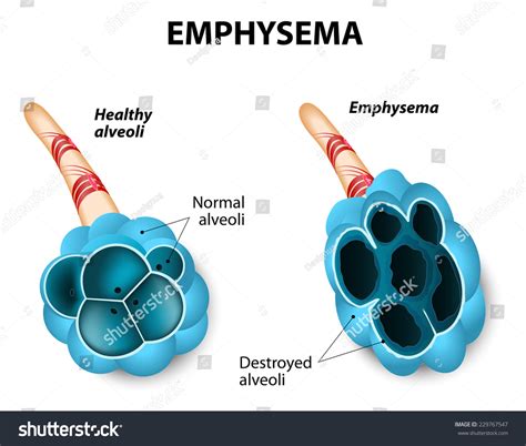 Emphysema Damage Air Sacs Lungs Chronic Stock Vector (Royalty Free ...