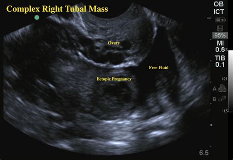 Ectopic Pregnancy | Emory School of Medicine