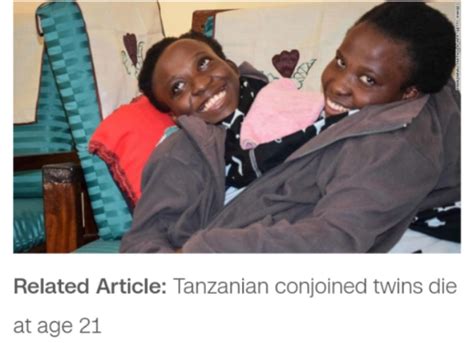 Nigerian Conjoined Twins Successfully Separated By 78-member Team In Abuja - Health - Nigeria