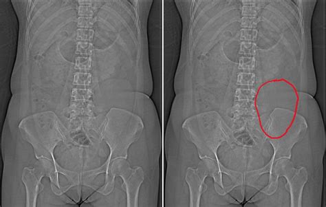 Mesenteric cyst – Radiology Cases