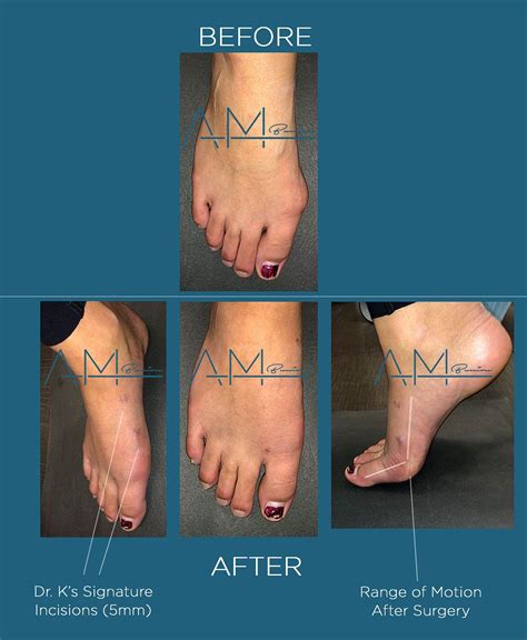 Bunion surgery before after bunion surgery pictures los angeles – Artofit