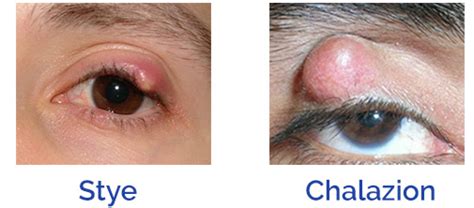 Stye Chalazion - Medical Terminology Blog