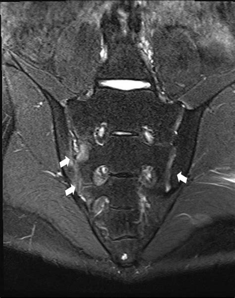 Magnetic resonance imaging (MRI) on diagnosis of juvenile ankylosing ...