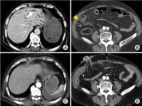 A 77-year-old man with superior mesenteric artery occlusion underwent... | Download Scientific ...