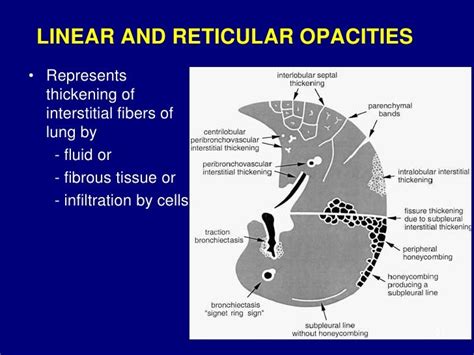 Technical aspect of hrct; normal lung anatomy & hrct findings of lung…