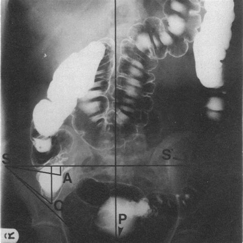 (PDF) McBurney's point—Fact or fiction?