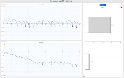 VisualEyes™ | Spontaneous Nystagmus | Interacoustics