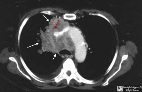 Learning Radiology - superior vena, caval, obstruction, svc