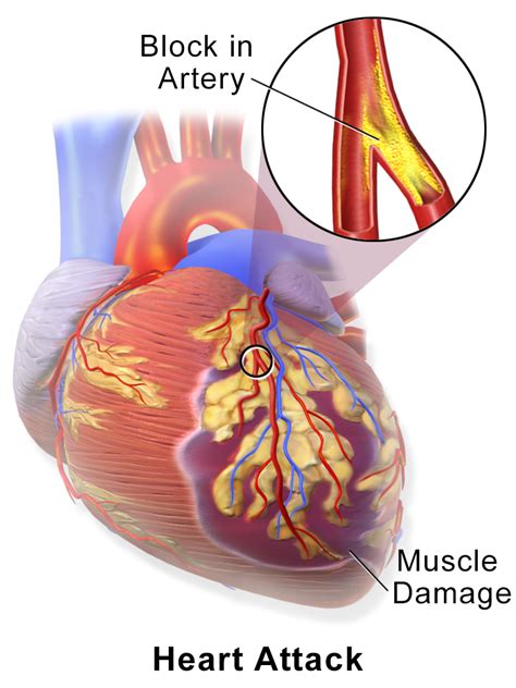 Myocardial infarction - Wikipedia