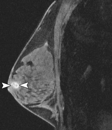 Nipple-Areolar Complex: Normal Anatomy and Benign and Malignant Processes | RadioGraphics