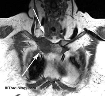 RiT radiology: Sternal Osteomyelitis