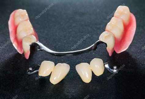 Removable dental prosthesis Stock Photo by ©obencem 53549263