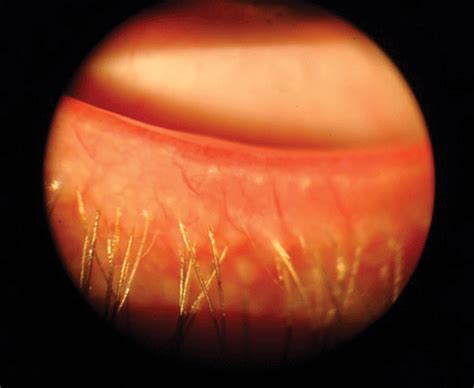 Meibomian Gland Dysfunction Expression