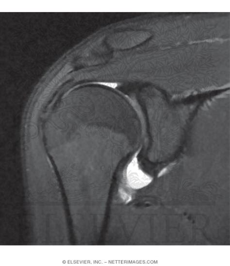 Shoulder Joint Imaging Studies: Coronal T2 MRI