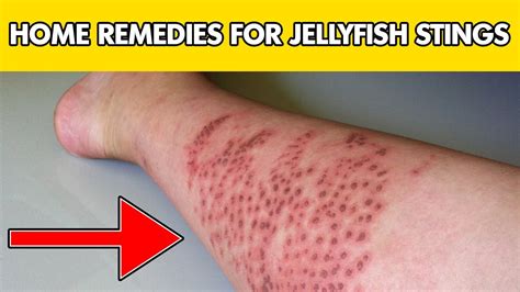 Jellyfish stings || how to treat jellyfish sting - YouTube