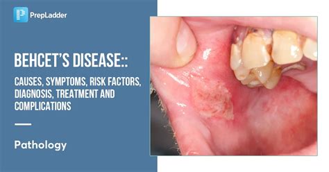 Behcet's Disease: Causes, Symptoms, Risk Factors, Diagnosis, Treatment and Complications