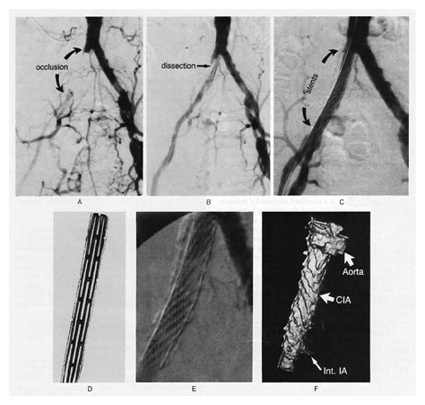 Endovascular Stents for Iliac Arterial Disease | NEJM