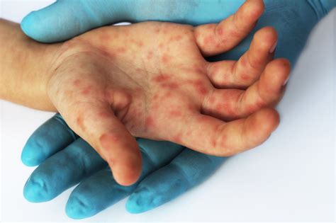 Enterovirus A71 Vaccine Effective in Preventing Non-Severe Hand, Foot, and Mouth Disease ...