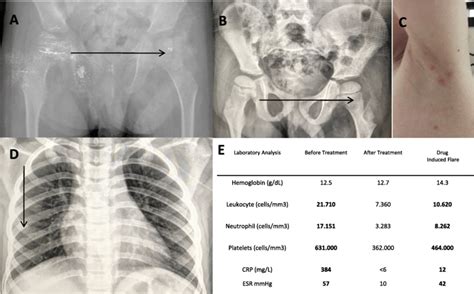 Clinical follow up. Femur x-ray before (a) and after treatment (b) with... | Download Scientific ...