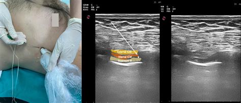 Ultrasound probe positioning and sonographic image of the intercostal... | Download Scientific ...