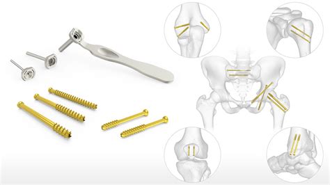 Cannulated Screw System | Acumed