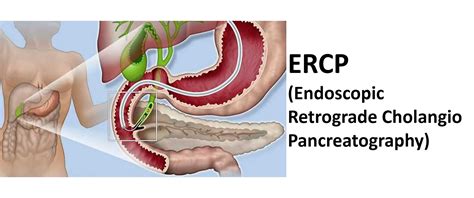 Ercp