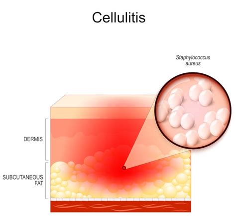 What is Foot Cellulitis? How to Prevent It and When to Worry