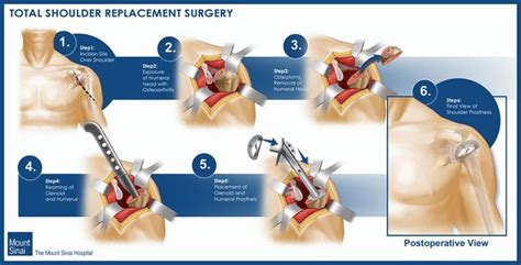 Orthopedic surgery, Orthopedics, Shoulder replacement surgery