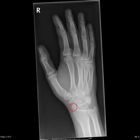 Triquetral Fracture