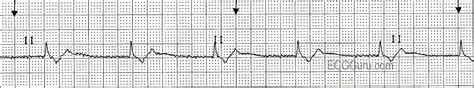 ECG Basics: Junctional Rhythm | ECG Guru - Instructor Resources