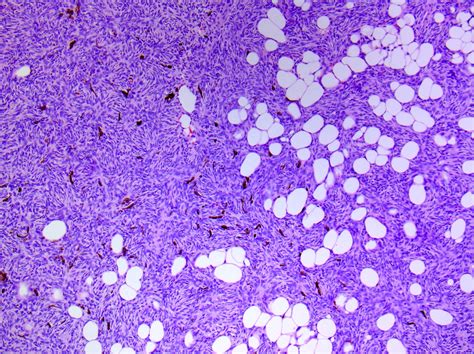 Dermatofibrosarcoma Protuberans Histology