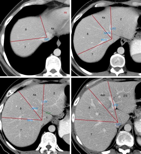 Liver Anatomy Segments