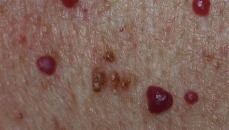 Cherry angioma: Symptoms, causes, and treatment