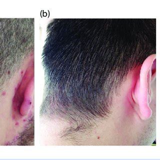 Case 1: At presentation (a); after 4 weeks treatment with calcipotriol... | Download Scientific ...