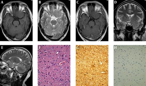 An Intracranial Gliosis Mimicking Neoplasm: A Dilemma | IJ Radiology ...