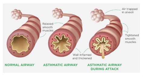 week six- COPD and asthma Flashcards | Quizlet