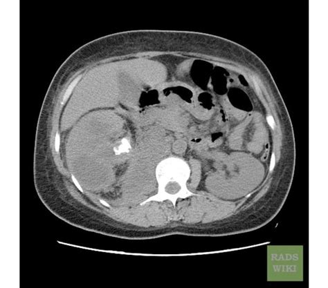 Pyelonephritis CT scan - wikidoc